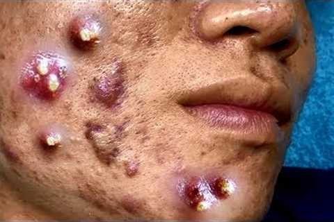Cystic Acne Extraction Big Blackheads Removal Relaxing HD Quality #1