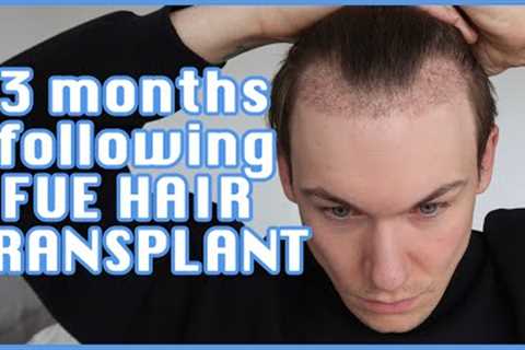 FUE Hair Transplant | Month 3 | Surgery, Swelling, Growth, Before &amp; After, Advice | Progress..