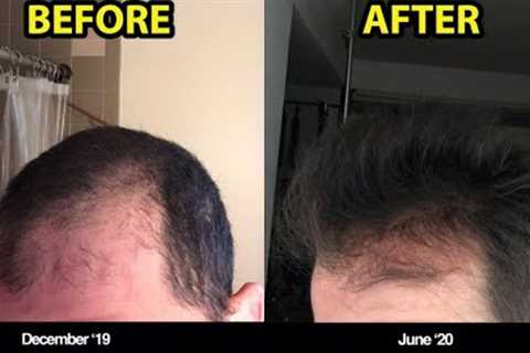 #1 REASON WHY YOU SHOULD BE MICRONEEDLING FOR HAIR LOSS (BEFORE/AFTER PHOTOS)!