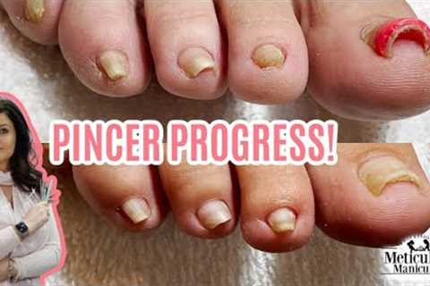 👣Pincer Toenail Pedicure Transformation Progress👣