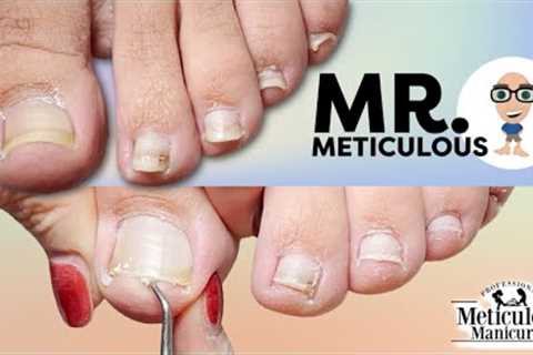 👣Impacted Toenail PEDICURE Cleaning on Mr. Meticulous👣
