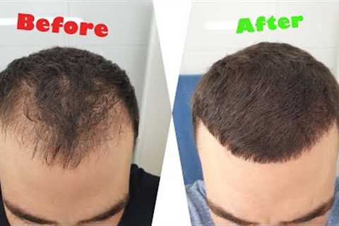 DHI Hair Transplant Results (6 Months Time Lapse)
