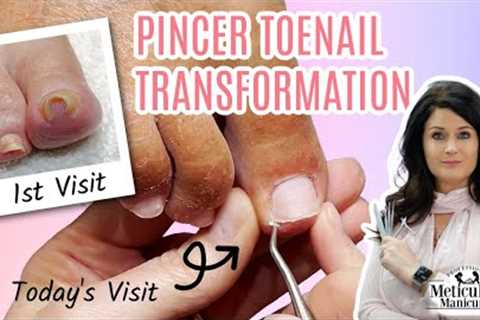 👣Pincer Ingrown Toenail Transformation How to Pedicure👣