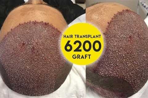 Hair Transplant 6200 Graft