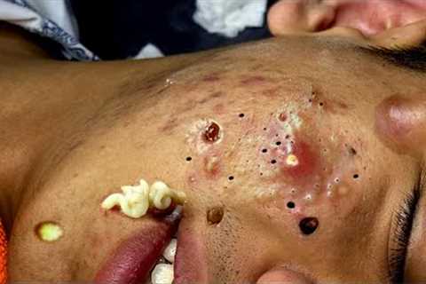 ( Big Hidden Acne ) Relax every day with Loan Nguyen Spa DANANG Office #80