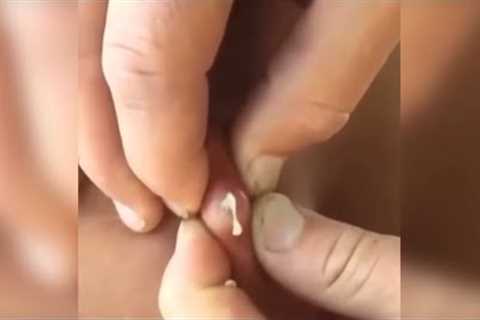Popping huge blackheads and Pimple Popping - Best Pimple Popping Videos 82