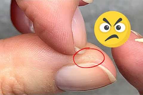 How to Treat This Annoying, Hard Skin?