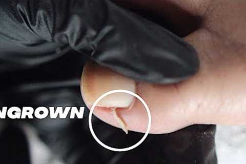 DIY INGROWN TOENAIL PEDICURE AT HOME //  Relaxing Pedicure