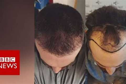 Hair loss: Fighting against my receding hairline  - BBC News