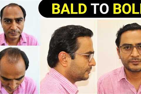 Full Hair Transplant Results 12 Months|Hair growth Timelapse|