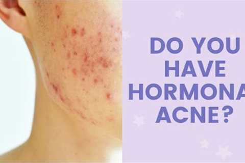 Do You Have Hormonal Acne? | FaceTory