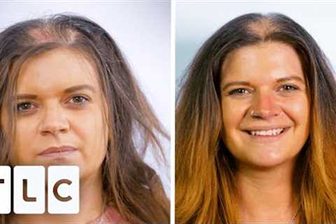 Blood Plasma Helps Compulsive Hair Puller Grow New Hair | The Hair Loss Clinic