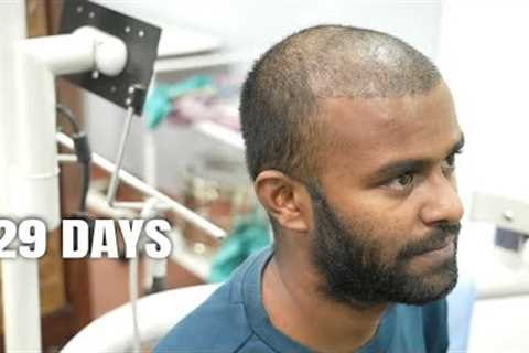 Hair Transplant | 29 Days Post Surgery | Shedding Phase | Donor Area Heal