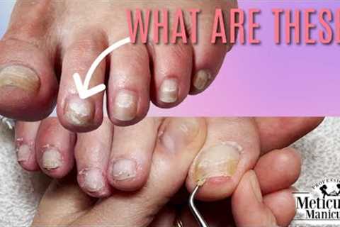 👣How to Fix White Patches on Toenails👣