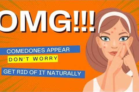 How To Get Rid Of Blackheads With Natural Ingredients ||blackheads removal