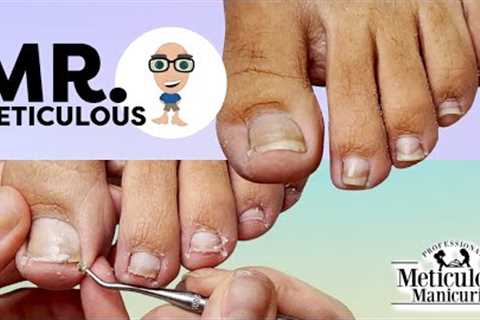 👣Mr. Meticulous Pedicure Tutorial Impacted Toenails with ASMR👣