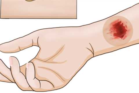 New insights from wireless smart bandage for healing chronic wounds