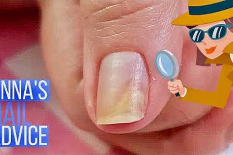 Why Does Nail Separate | Causes | Early Treatment of Onycholysis [Anna's Nail Advice]
