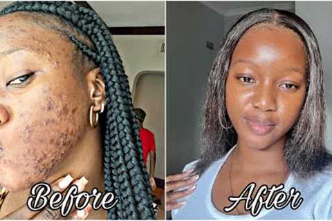 How I finally cleared my acne prone skin + Skin care routine🧴*with photo evidence*