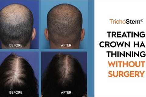 How Crown Hair Loss can be Treated for Thicker Hair Growth