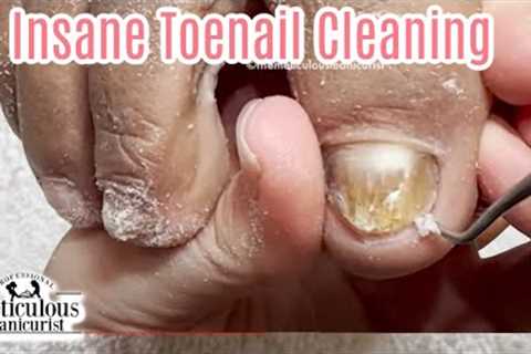 👣Pedicure on the Toenail Fungus Reversal Process👣