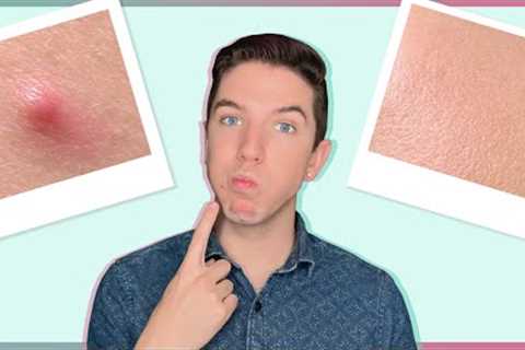 How I Get Rid of a Pimple in One Day