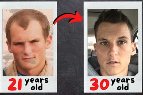 My EPIC Hair-Loss Prevention Journey [Before and After]