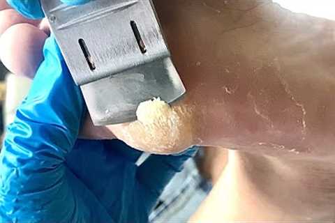 Callus removal from feet&amp;Foot scraping dead skin【Xiao Yan pedicure】#stress 33