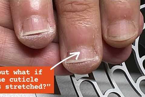 Overgrown Skin Around the Nails | Simple Solution