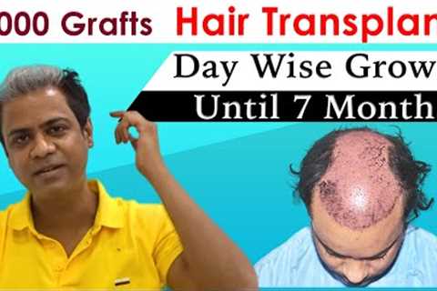 Hair Transplant in India | 5000 Grafts| Day wise Growth until 7 Months | MEDISPA India