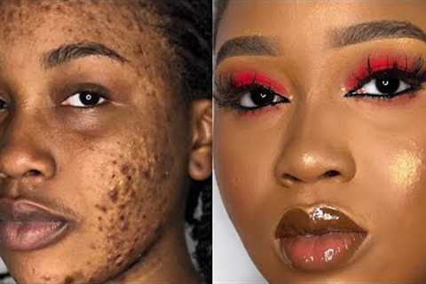 HOW TO COVER ACNE DARK SPOTS /MARKS &amp; HYPERPIGMENTATION | FOUNDATION ROUTINE for..