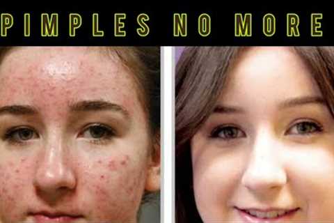 Pimples Face Clean Tips || Natural 2tips || 100% Working || Only Free || Skin Care Tpis