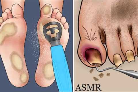 ASMR Climber's plantar calluses and rot toenails care animation