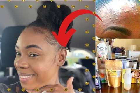 How I Prevent Acne | Skin Care Series 1 | My Daily Skin Routine