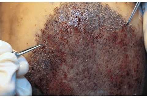 Watch the Full FUE Hair Transplant Procedure in a 60 Second Time Lapse!