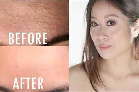 How To Get Rid of Whiteheads/Closed Comedones | Vivienne Fung