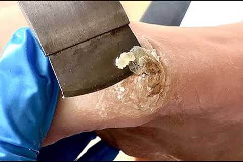 Callus removal from feet&amp;Foot scraping dead skin【Xiao Yan pedicure】#asmr