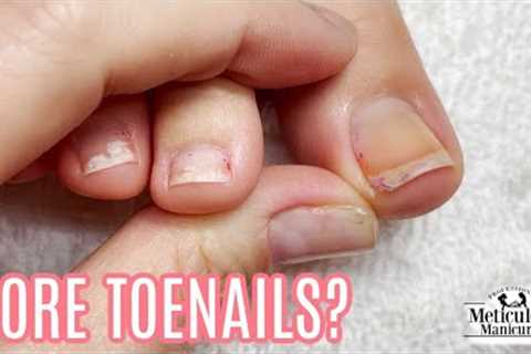 👣Sore Toenails: Is it Impacted or Ingrown?👣