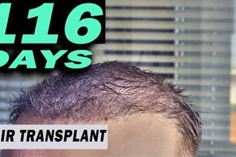 FUE Hair Transplant Day 102 - 116 Istanbul, Turkey TIME LAPSE