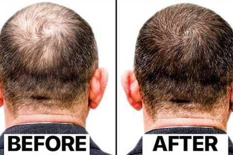 The Truth Behind This New Hair Loss Treatment | Exosomes