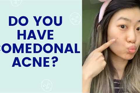 Do you have Comedonal Acne? | FaceTory