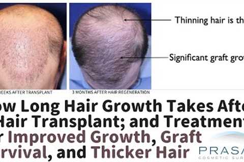 How Long Hair Regrowth Takes after a Hair Transplant, and Improving Growth Rate and Results