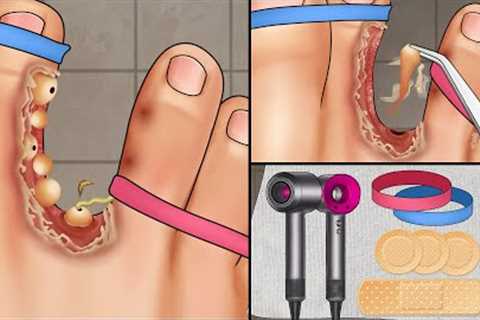 ASMR Treatment athlete's foot and warts between toes at home | Foot care animation