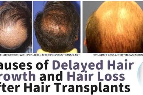 Hair Transplants - Causes of Lack of Hair Growth, and Hair Loss After Transplant Surgery