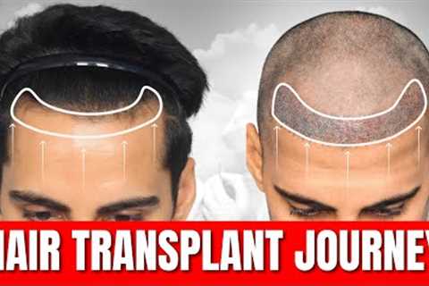 Hair Transplant Time Lapse | Step by Step Hair Transplant Surgery Time Lapse | NW Grade 2 | QHT