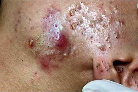 Blackhead removal | pimple remove | pimple popping | pimple popping videos blackheads