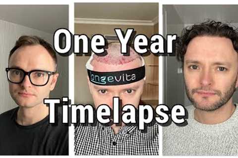 FUE Hair Transplant - One Year Later Timelapse