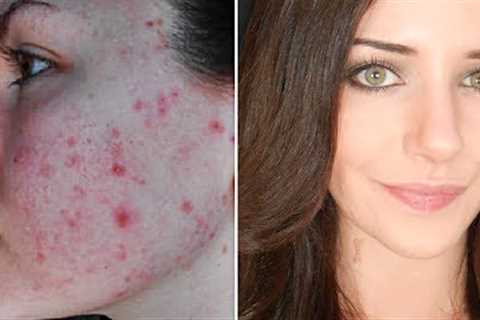 How To Cover Acne &amp; Scars (IF You Want To) | Easy Makeup Transformation Routine