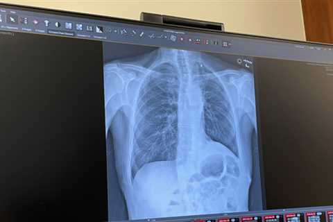 … Lung cancer free!?