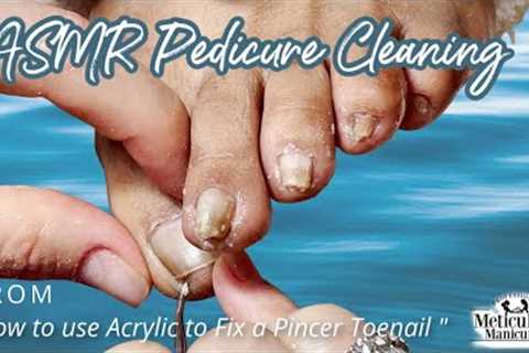 👣ASMR Pedicure Cleaning💆‍♀️How to use Acrylic to Fix a Pincer Toenail Tutorial👣